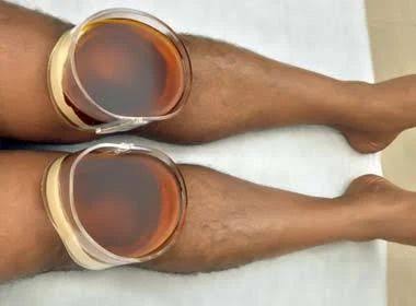 Embracing Tradition: How Janu Basti Healed Anjali's Knee Pain