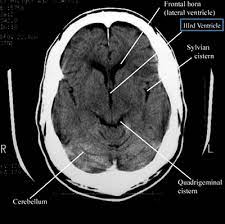 Unveiling Clarity: How a Head CT Scan Transformed Rajesh's Life