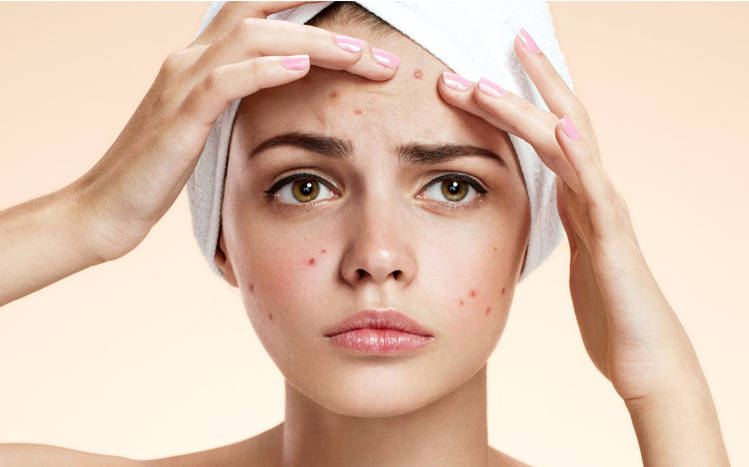 Transform Your Skin: Riya's Journey with Our Acne Facial Treatment