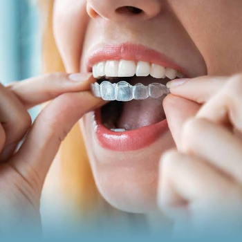 Transform Your Smile: How Invisalign is Changing Lives in India