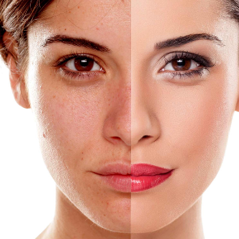 Embrace Radiance: Transform Your Skin with Pigmentation Treatment at Wisteria Beauty Salon & Spa