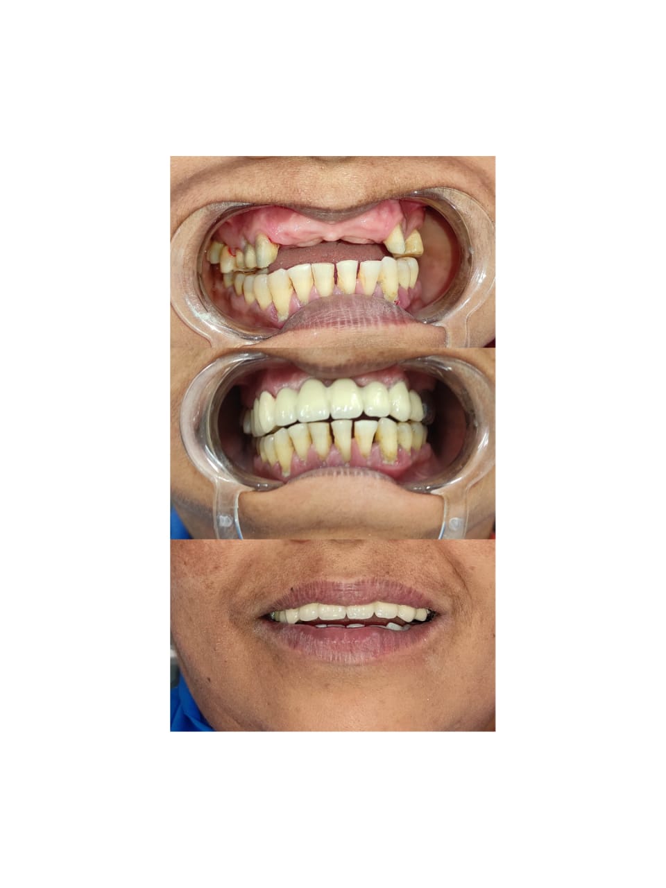Transforming Smiles and Lives: Replacing Missing Teeth with PFM Metal Ceramic Caps