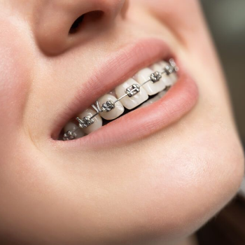 Transforming Smiles: How Shubham Dental Clinic Helps You Embrace Your True Self with Teeth Braces
