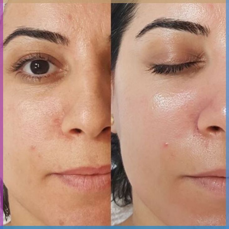 Revitalize Your Radiance: How Allura Unisex Salon's Bleaching Service Transforms Lives