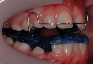 Transforming Smiles and Lives: The Power of Mayo Functional Appliances in Orthodontics | My family dentist dental implant center (MFD-HARIDWAR)