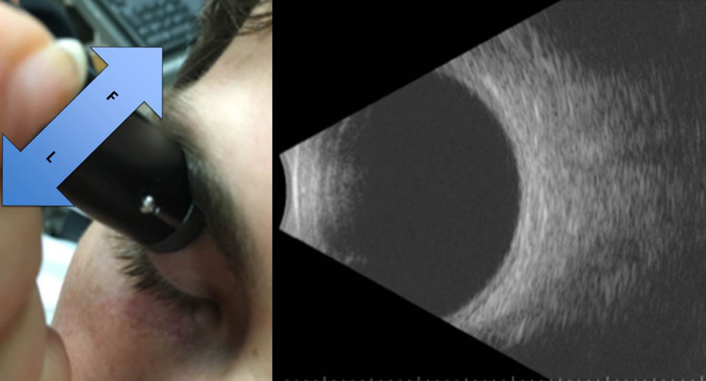 Seeing Clearly: How B-Scan Ultrasonography of the Eye Transforms Lives