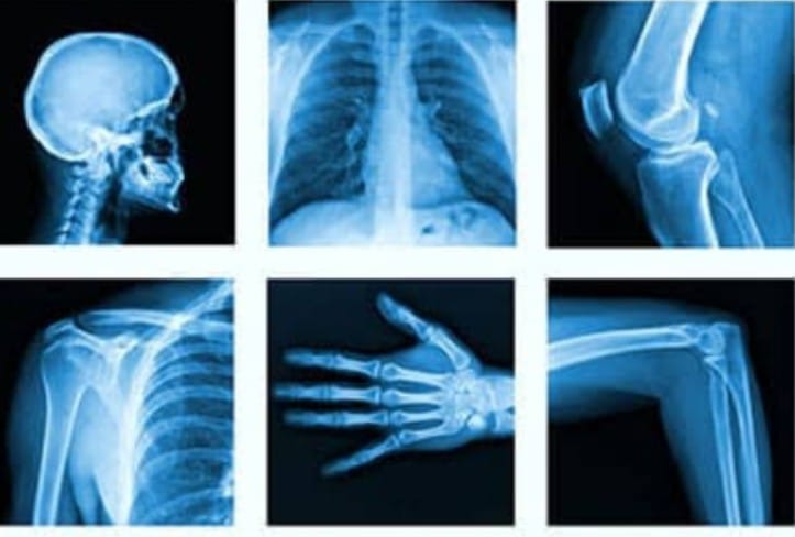 A Life Transformed: How X-Ray Services Became the Beacon of Hope for Meena