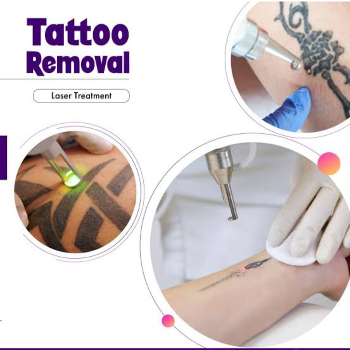 Embrace a Fresh Start: Tattoo Removal Laser Treatment at Sai Sparsh Hospitals