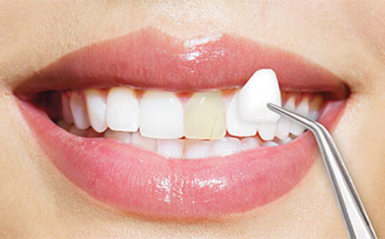 Transforming Smiles, Transforming Lives: The Power of Dental Laminates and Veneers