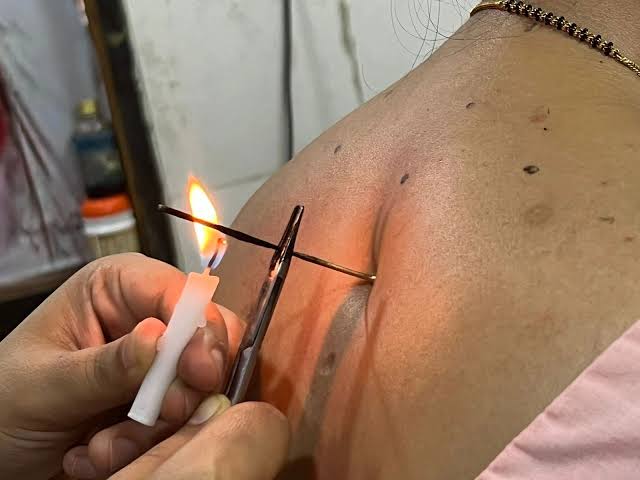 Embracing Agnikarma: A Journey to Pain-Free Living