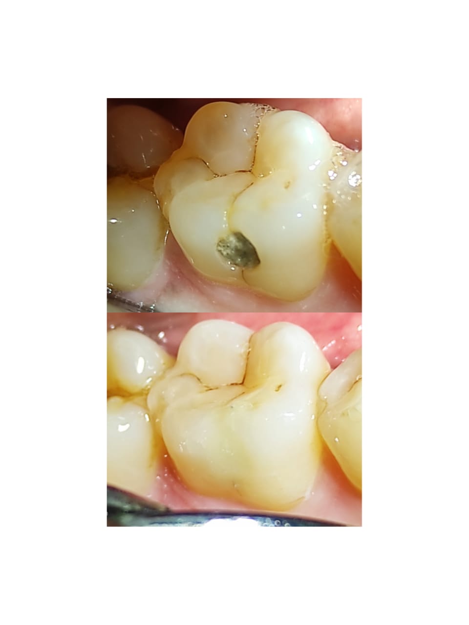 Transform Your Smile: How Light Cure Composite Fillings Can Change Lives