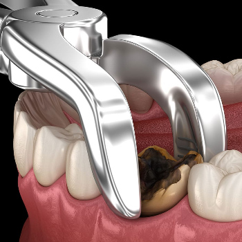 The Journey to a Pain-Free Smile: How Impacted Tooth Extraction Changed Anjali's Life