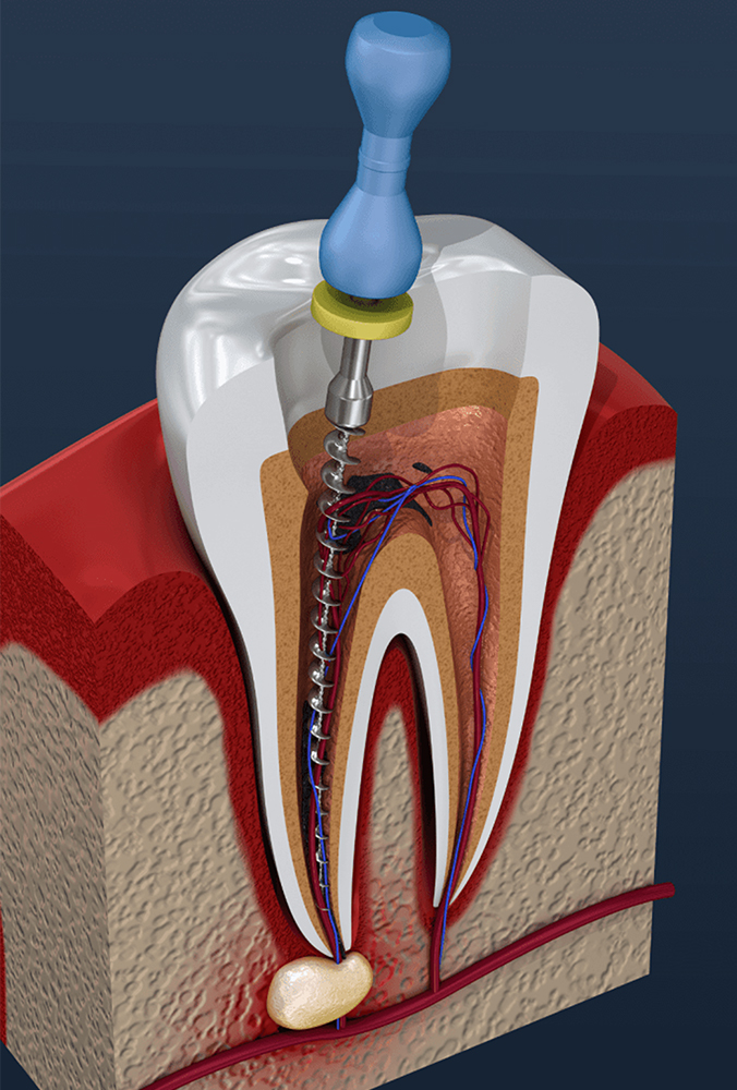 Transform Your Smile: How Root Canal Treatment Can Change Your Life