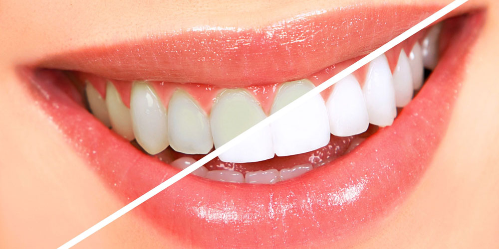 Teeth Bleaching Clinics in Bengali Square Indore