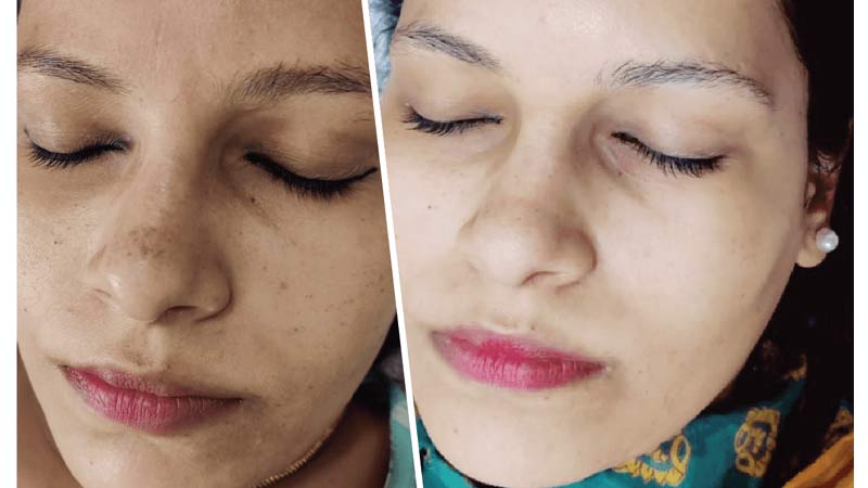 Rediscover Your Radiance: Anjali's Journey with Skin Treatments | Neelima singh