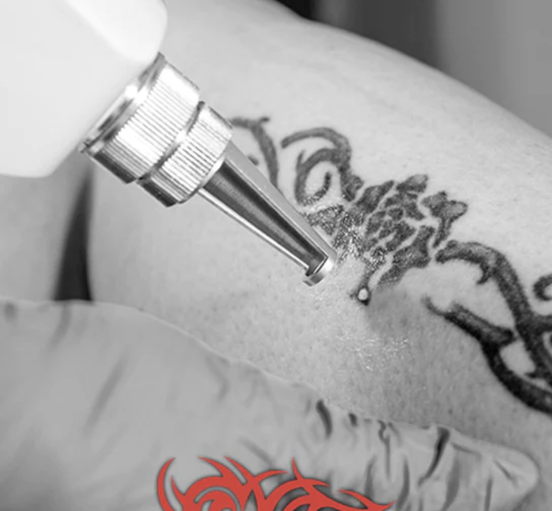 Rediscover Yourself with Tattoo Removal: A Journey of Transformation