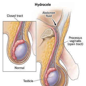 A New Lease on Life: How Jeet Hospital's Hydrocele Service Transformed Rajesh's World