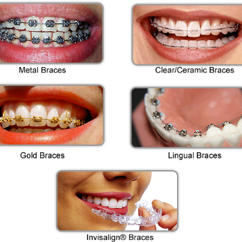 Transforming Smiles: How Dental Braces Changed Riya's Life