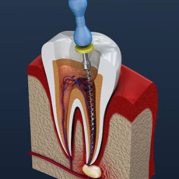 A New Smile: How Rohan Found Relief from Dental Pain with Root Canal Treatment