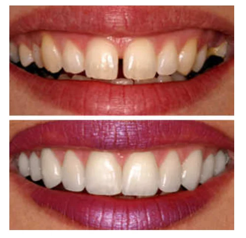 Transforming Smiles, Transforming Lives: The Power of Smile Designing