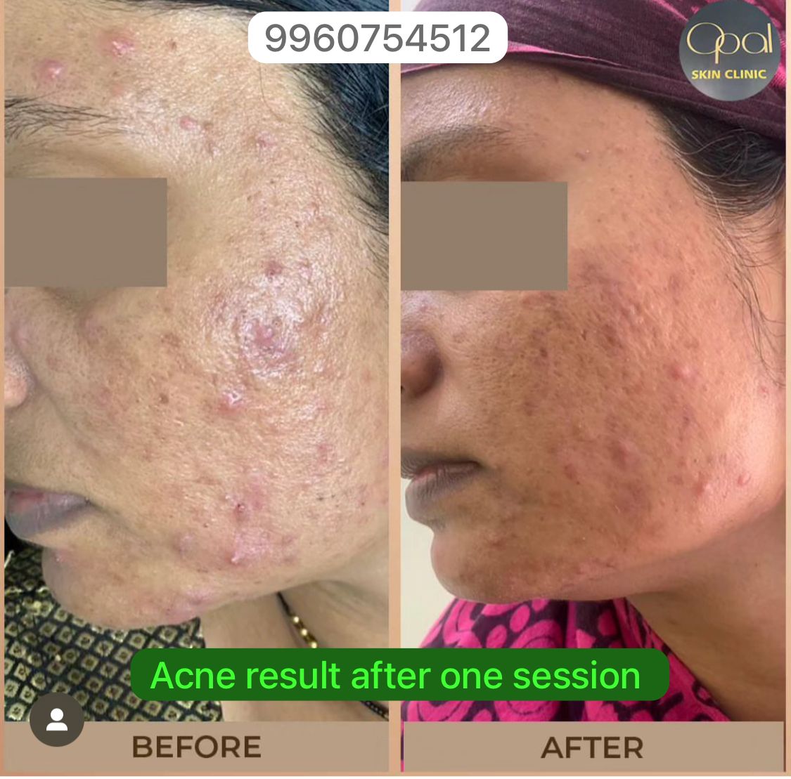 Transforming Lives: How Acne Treatment at Opal Skin Clinic Changed Riya's Story