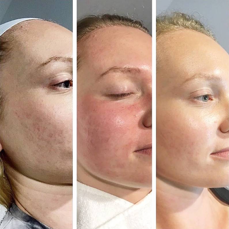 Rediscover Your Youthful Glow with PRP Treatment