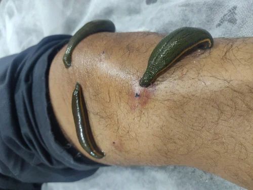 From Pain to Relief: How Leech Therapy Transformed Anjali's Life