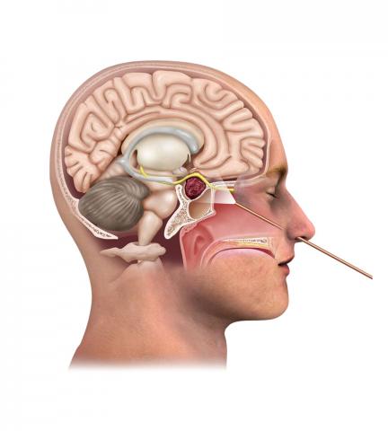 A New Lease on Life: How Skull Base Surgery Transformed Rohan's Future