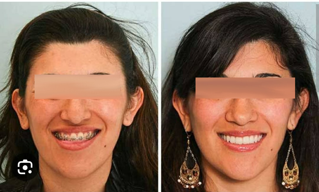 Transforming Smiles and Lives: The Journey of Orthodontic Braces