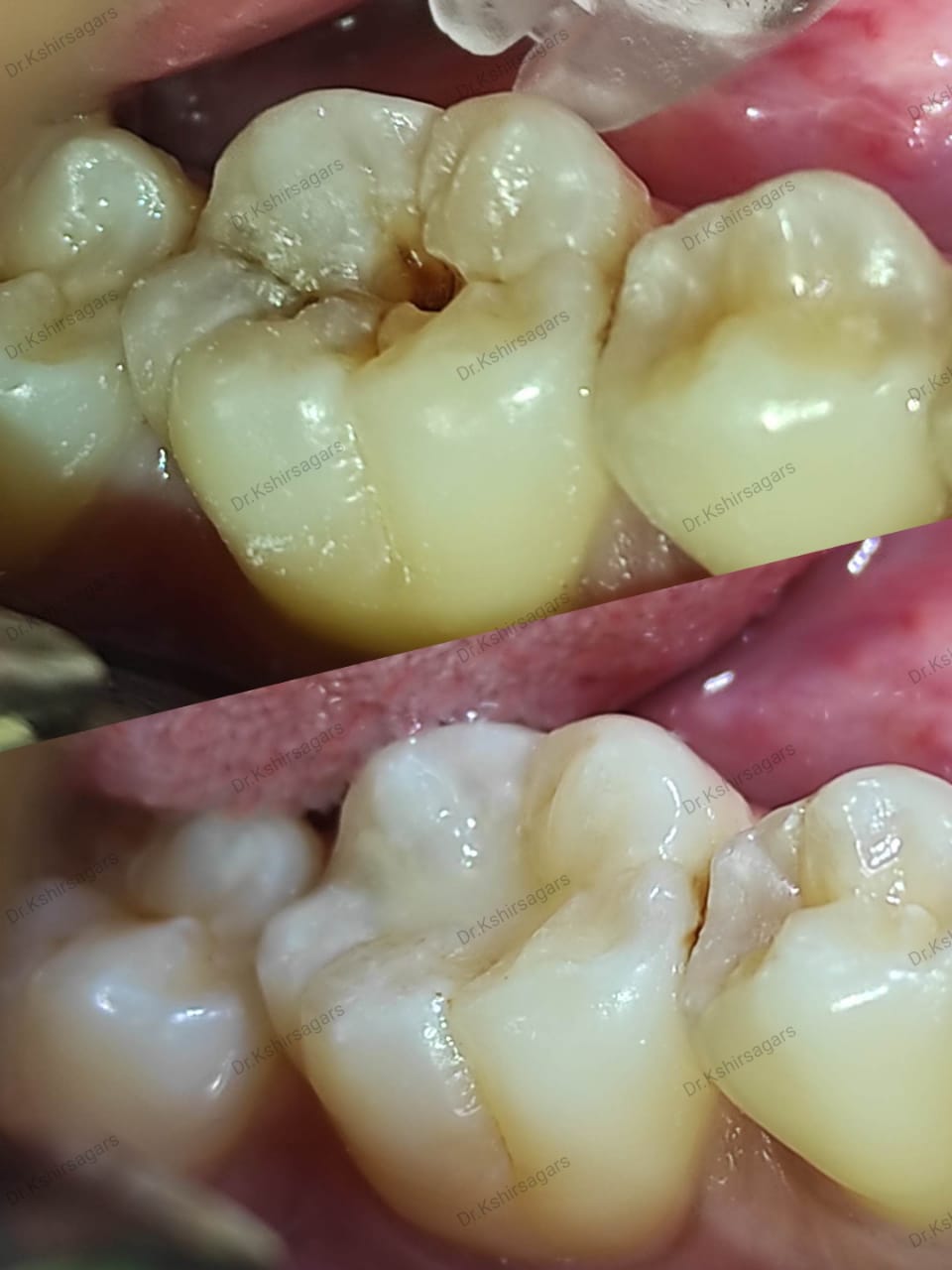 Transform Your Smile with Light Cure Composite Fillings: A Journey to Confidence