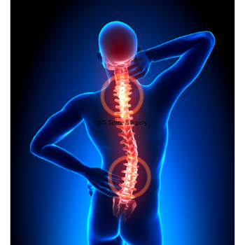 Transforming Lives: How MIS Spine Surgery Gave Rakesh His Life Back