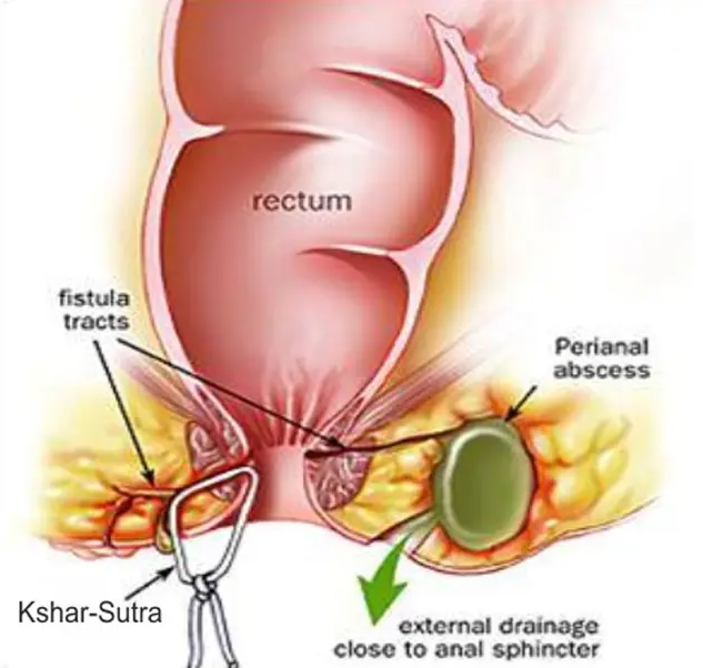 Healing Stories: How Kshar Sutra Treatment Transformed Rajesh's Life