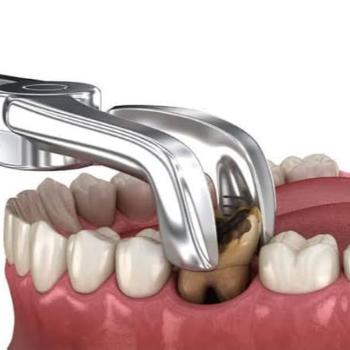 A Journey to a Brighter Smile: How Tooth Extraction Transformed Priya's Life