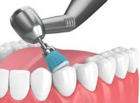 Transform Your Smile: Rekha's Journey to Confidence with Teeth Cleaning and Polishing