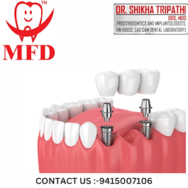 MONSOON OFFER-FOR DENTAL IMPLANT | My family dentist dental implant center (MFD-HARIDWAR) 