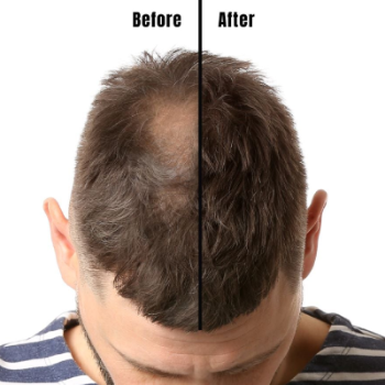 Non surgical hair replacement-https://i-media.vyaparify.com/vcards/products/120058/product_1737530567.png Image