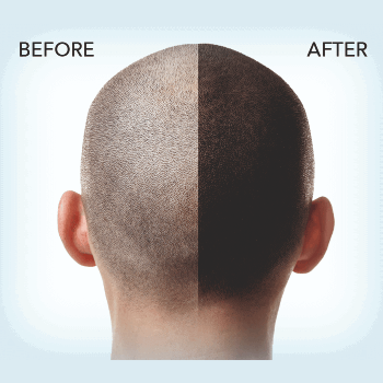 Hair Transplant Solution-https://i-media.vyaparify.com/vcards/products/120108/product_1737531618.png Image