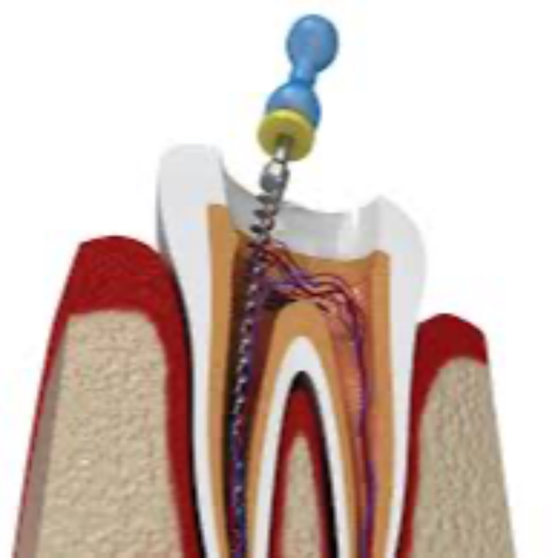 Root Canal Treatment at Meerpet-https://i-media.vyaparify.com/vcards/products/302685/product_1756920613_68b87b2529e4d.jpeg Image