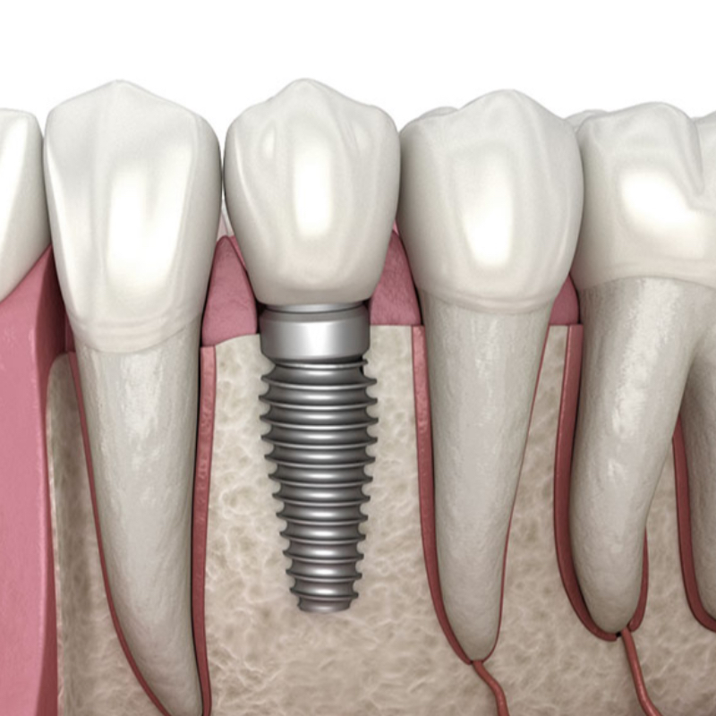 Dental Implant In Hasthinapuram-https://i-media.vyaparify.com/vcards/products/302716/product_1757010870_68b9dbb6dc385.jpeg Image