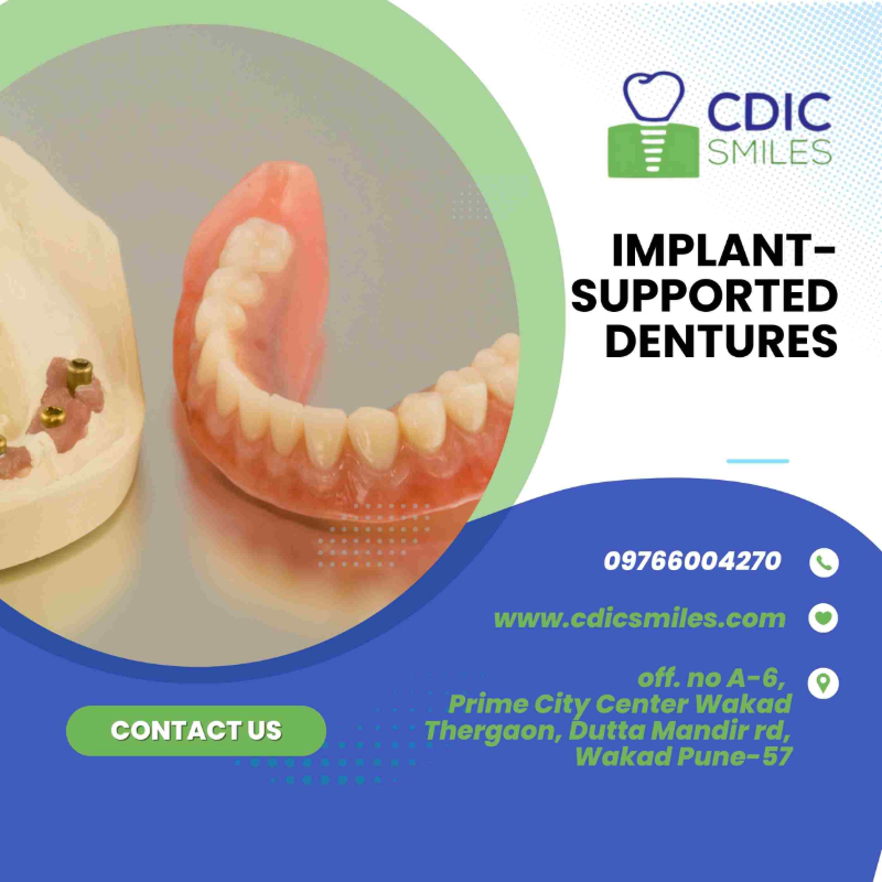 Implant-Supported Dentures in Wakad, Pune | Secure &Stable-https://i-media.vyaparify.com/vcards/products/303893/product_1758527856_68d10170e52a7.jpeg Image