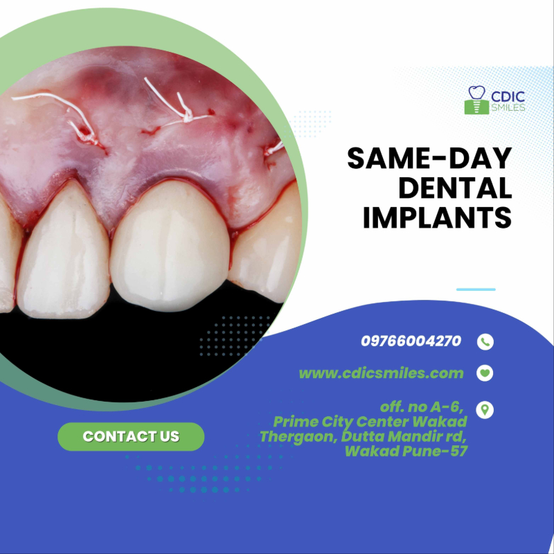 Single Implants in Wakad, Pune | Precise & Natural Tooth Replacement-https://i-media.vyaparify.com/vcards/products/304276/product_1758961896_68d7a0e857682.jpeg Image