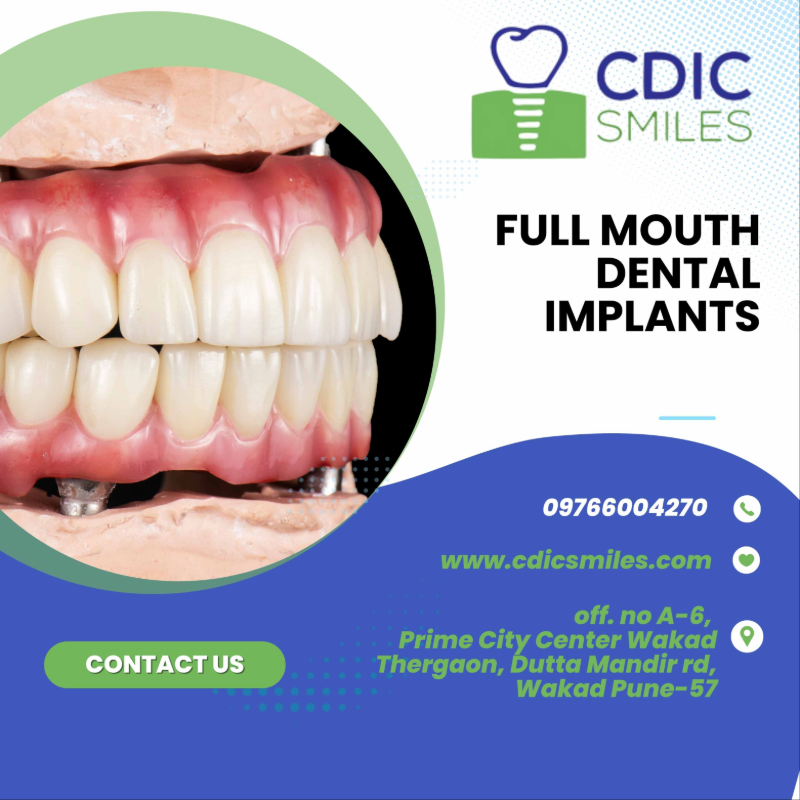 Full-Mouth Implants in Wakad, Pune | Complete Smile Restoration in Pune-https://i-media.vyaparify.com/vcards/products/304277/product_1758962123_68d7a1cbe4e28.jpeg Image