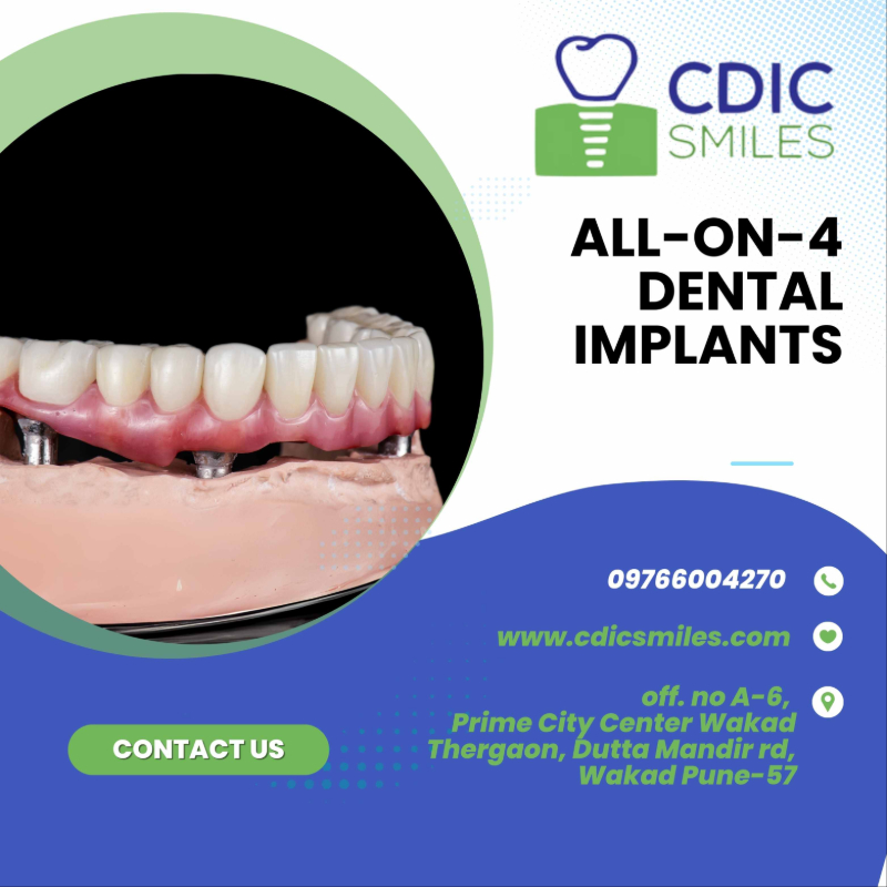 All-on-4 Implants in Wakad, Pune | Stable Full-Arch Replacement in your budget-https://i-media.vyaparify.com/vcards/products/304278/product_1758962302_68d7a27e2113e.jpeg Image
