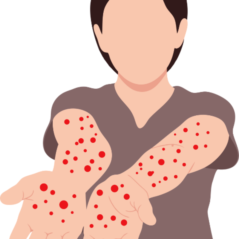 Psoriasis and Skin Disorders – Homeopathy Treatment in Thane-https://i-media.vyaparify.com/vcards/products/305852/product_1764221327_6927e18fbb300.jpeg Image