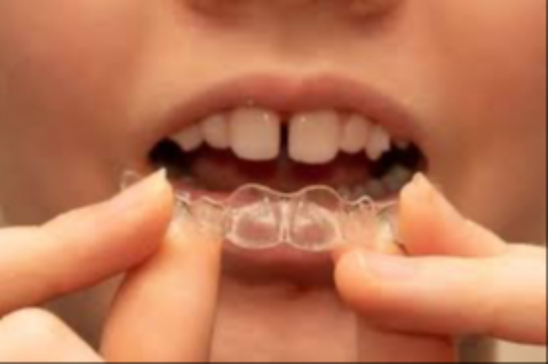 Clear aligners vs traditional braces At Dr Care Dental Hospital-https://i-media.vyaparify.com/vcards/products/307385/product_1768289483_6965f4cbd8ea9.jpeg Image