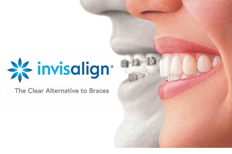 Cost of Invisalign aligners treatment At Dr Care Dental Hospital-https://i-media.vyaparify.com/vcards/products/307388/product_1768289886_6965f65e68d13.jpeg Image