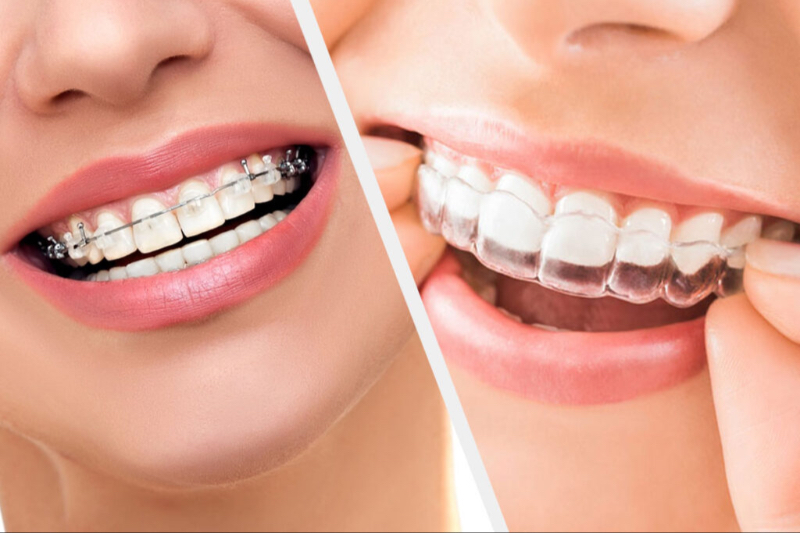 Does Invisalign work for crowded teeth At Dr Care Dental Hospital-https://i-media.vyaparify.com/vcards/products/307389/product_1768290035_6965f6f326da9.jpeg Image