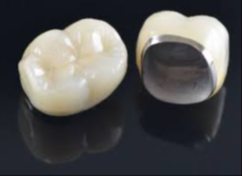 Dr Care Dental Hospital Metal Ceramic Crown Teeth Capping In Hyderabad At Affordable Cost-https://i-media.vyaparify.com/vcards/products/311377/product_1773677336_69b82b181ba2a.jpeg Image