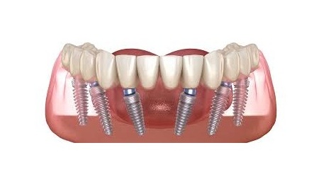 Dr Care Dental Hospitals Full Mouth Fixed Teeth With Dental Implants In LB Nagar, Hyderabad-https://i-media.vyaparify.com/vcards/products/312297/product_1775324713_69d14e29713ce.jpeg Image
