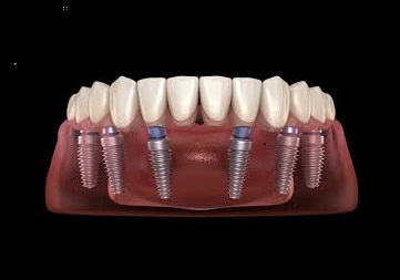 Dr Care Dental Hospitals Full Mouth Fixed Teeth With Dental Implants In Turkayamjal, Hyderabad-https://i-media.vyaparify.com/vcards/products/312302/product_1775325624_69d151b8178c0.jpeg Image